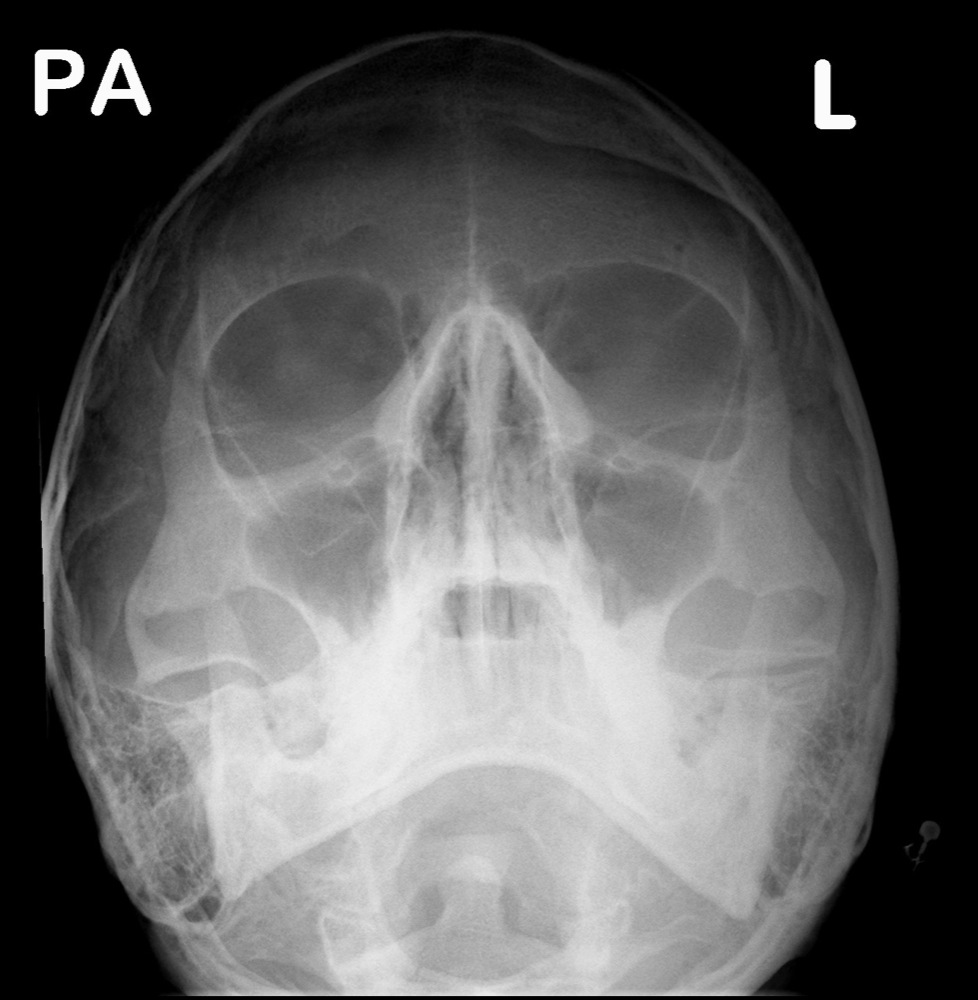 Facial Xray 91