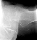 Missed subcapital fracture left NOF - first attendance