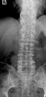 Spondylosis lumbar spine