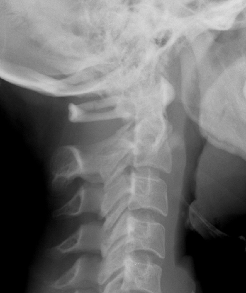 cervical spine x ray interpretation