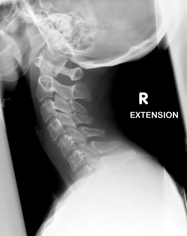A drawing of a lateral spinal radiograph describing the rib-index