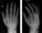 Fracture-dislocation 4th/5th plus fractured hamate