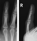 Avulsion fracture at insertion of volar plate