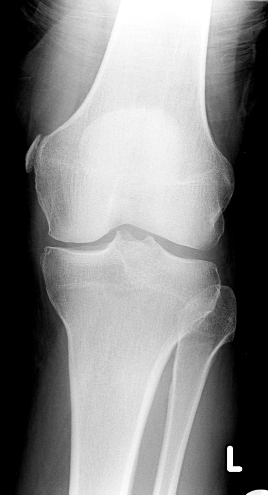 Лигаментоз крестообразных связок коленных. Пеллегрини коленного сустава. Лигаментоз коленного сустава рентген. Эпикондилит коленного сустава рентген.