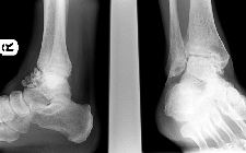 Synovial osteochondromatosis - ankle