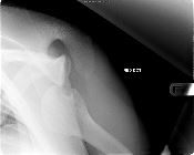 Anterior dislocation, Hill-Sachs defect