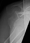 Anterior dislocation, fracture greater tuberosity