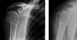Greater tuberosity, surgical neck fractures