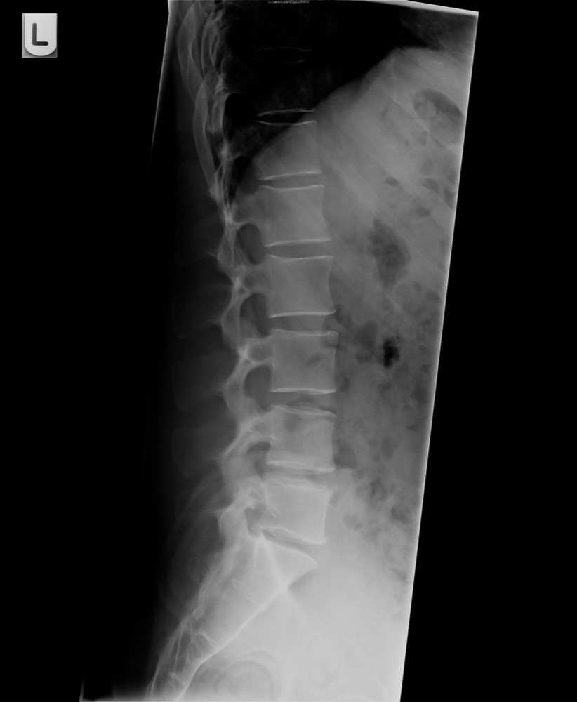 lumbar vertebrae anatomy xray