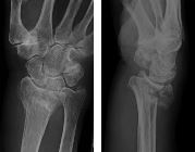 Avulsion fracture of ulnar styloid (and Colles' fracture)