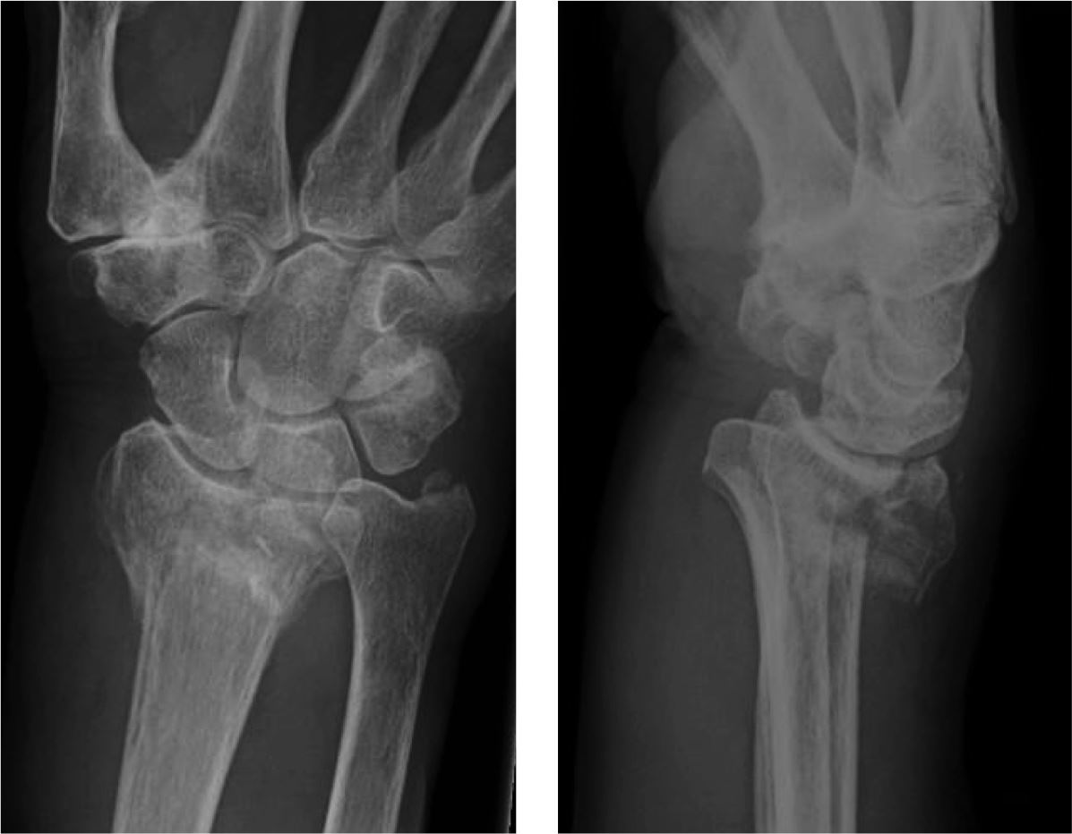 comminuted fracture wrist