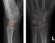 Comminuted fractures proximal capitate and lunate, with impaction and rotation