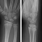 wrist torus fracture